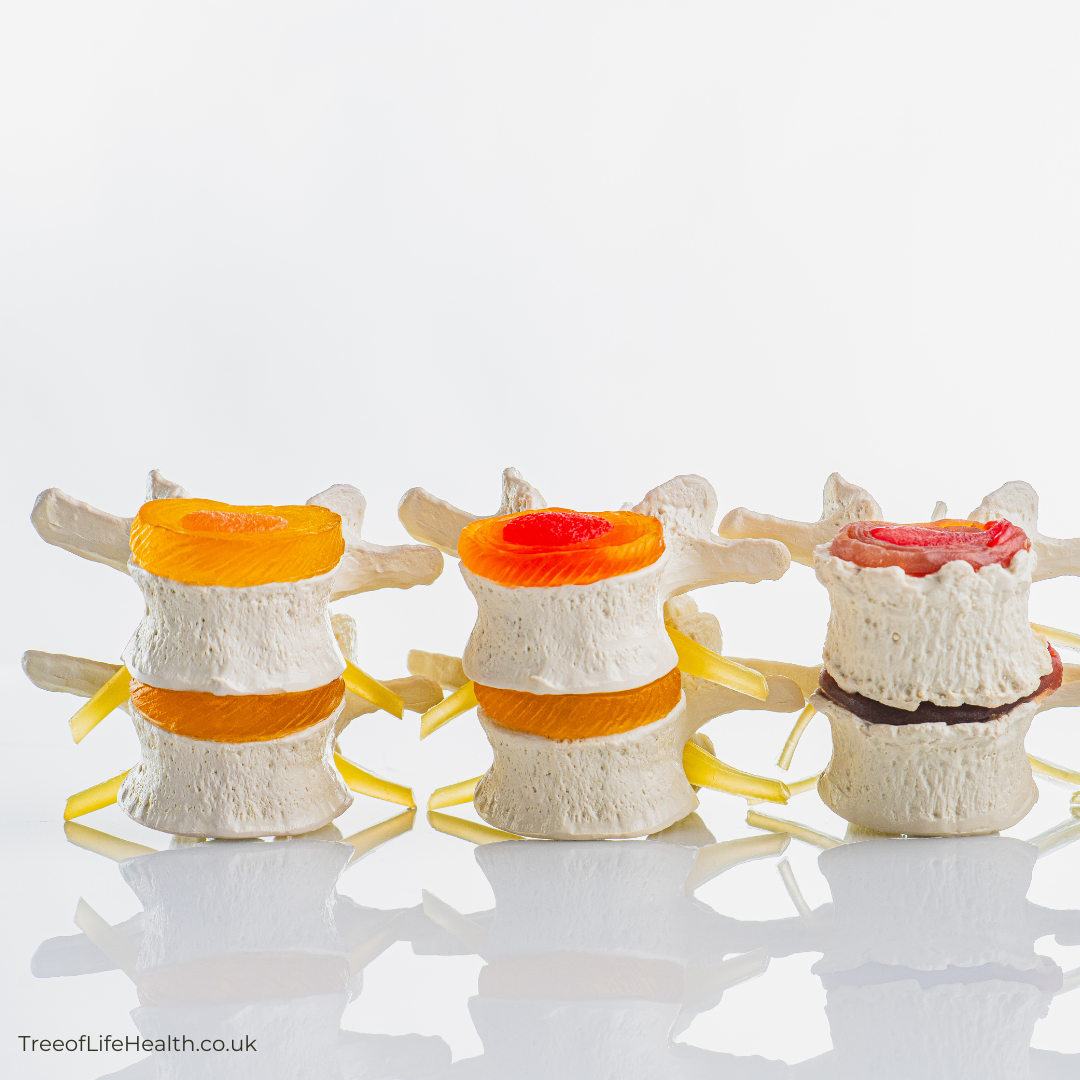 image of spine at various phases of spinal disc health.